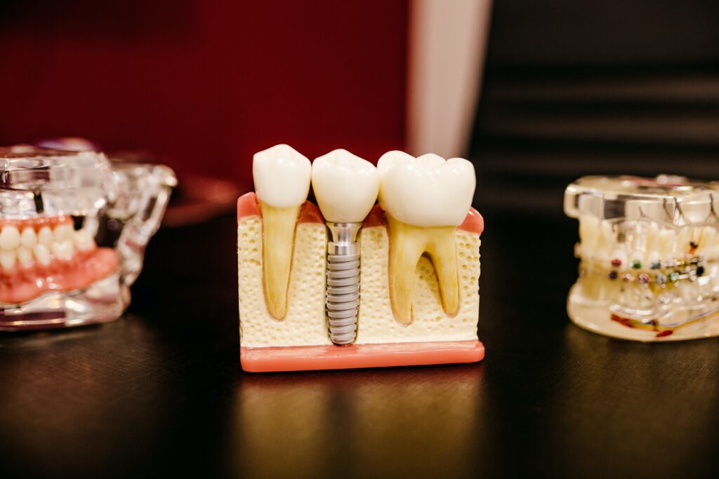 Dental Implants: A Permanent Solution for Missing Teeth